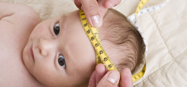 تشخیص میکروسفالی