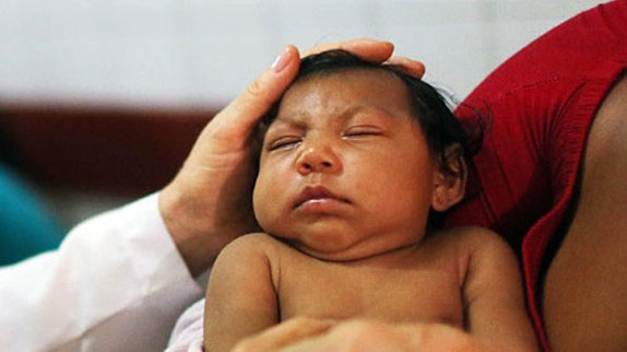 میکروسفالی یک نقص مادرزادی 